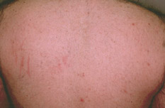 Back Hair Removal After