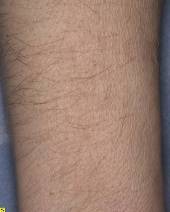 Arm Hair Removal Before