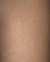 Arm Hair Removal After