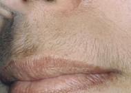 Upper Lip Hair Removal Before
