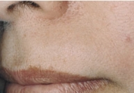 Upper Lip Hair Removal After